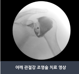 어깨 관절강 조영술 치료 영상